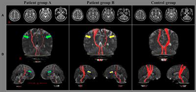 Differences in Corticoreticulospinal Tract Injuries According to Whiplash in Mild Traumatic Brain Injury Patients